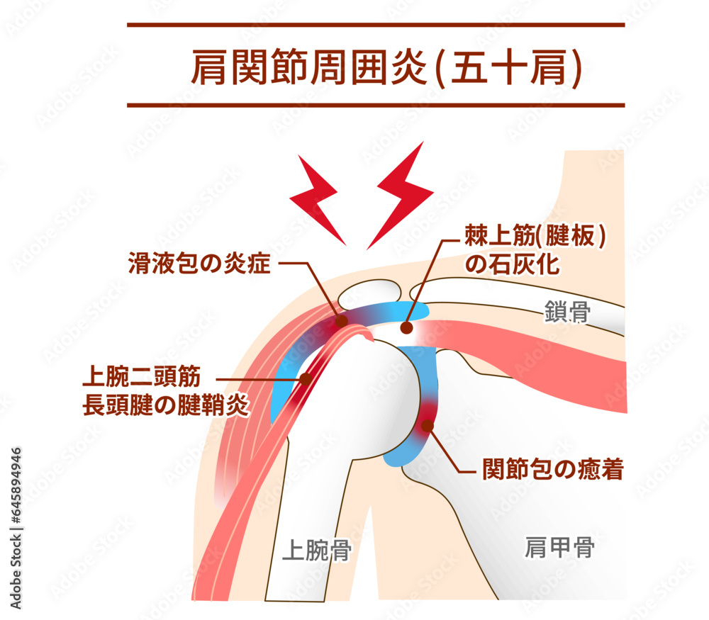 4. ストレスと肩の関係